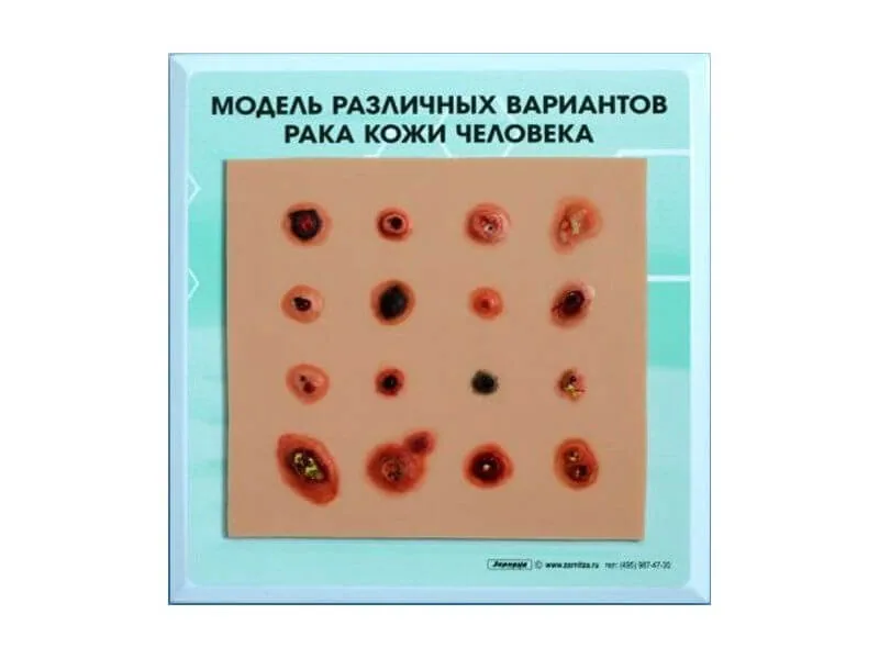 Модель Зарница вариантов рака кожи человека